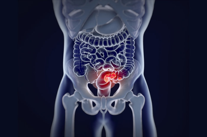 Estudo mostra que quase metade dos casos de c&acirc;ncer colorretal agora ocorre em pacientes mais jovens