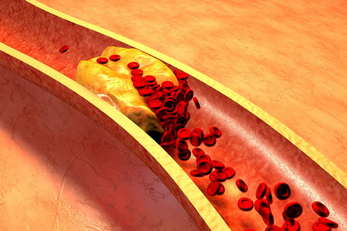 O risco de ataque card&iacute;aco em mulheres aumenta mesmo que as art&eacute;rias n&atilde;o estejam t&atilde;o obstru&iacute;das quanto as dos homens